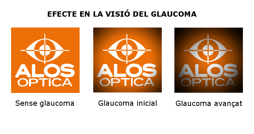 El lladre silenciós de la vista: el Glaucoma.